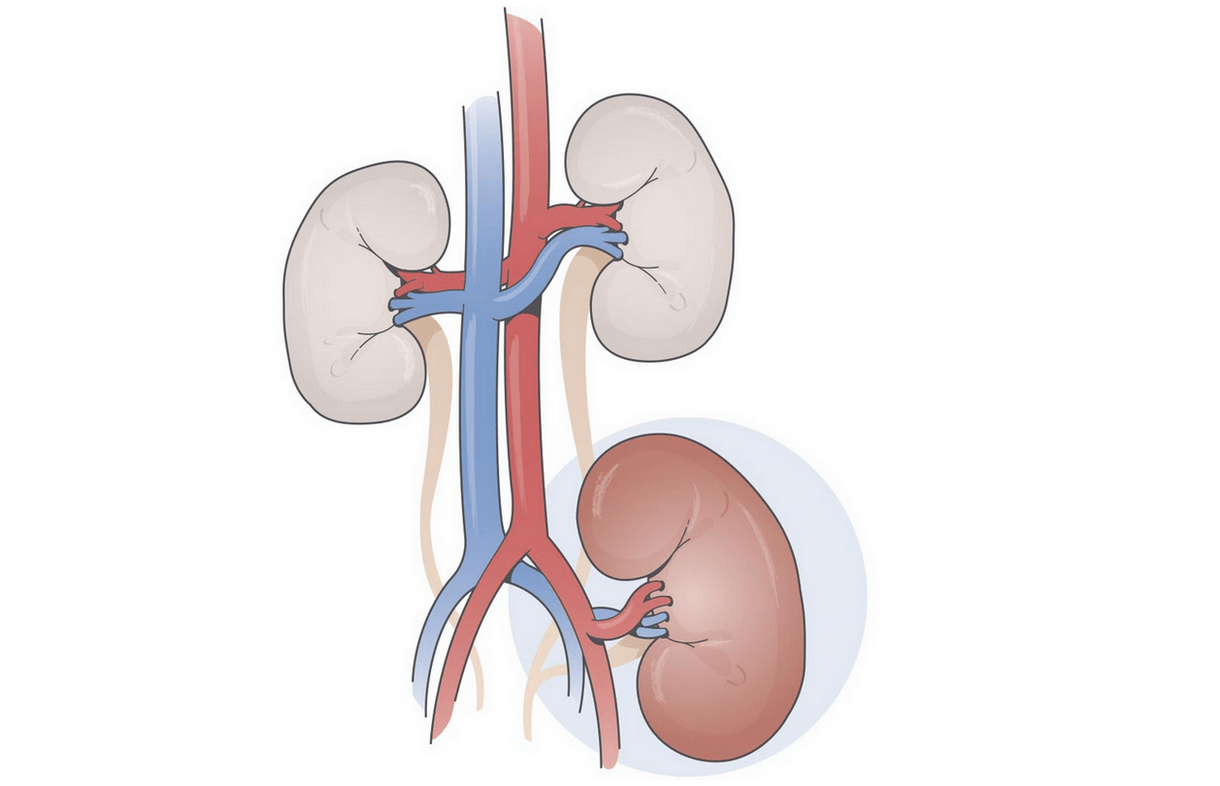 Малюнок пересадженої нирки